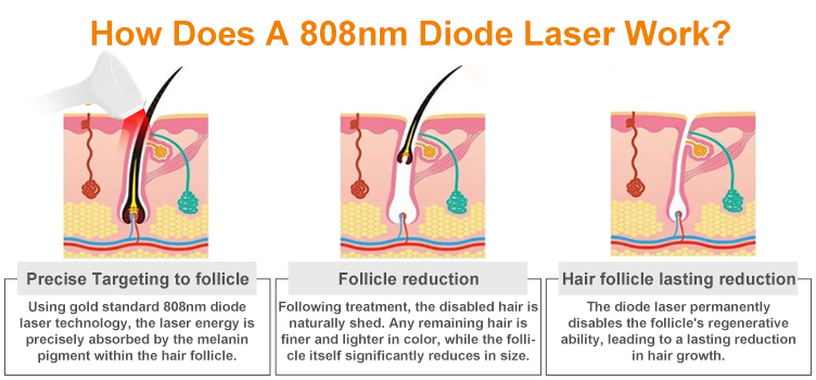 The principle of the diode laser hair removal