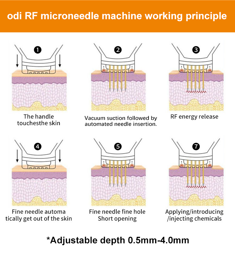 rf-microneedle-machine-for-face-and-body-working-principle