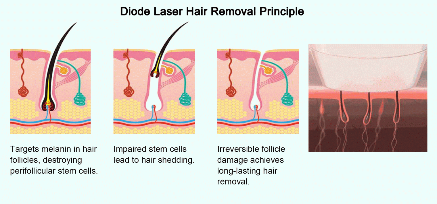 diode-laser-hair-removal-principle