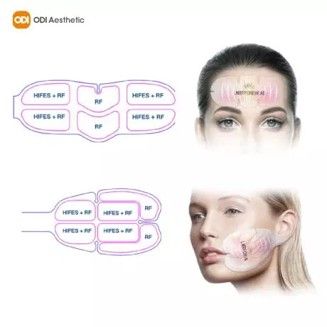 emsculpt face-working-principle