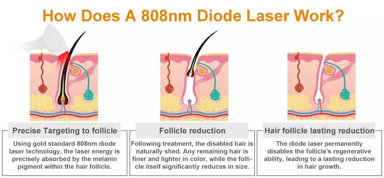 The principle of the diode laser hair removal