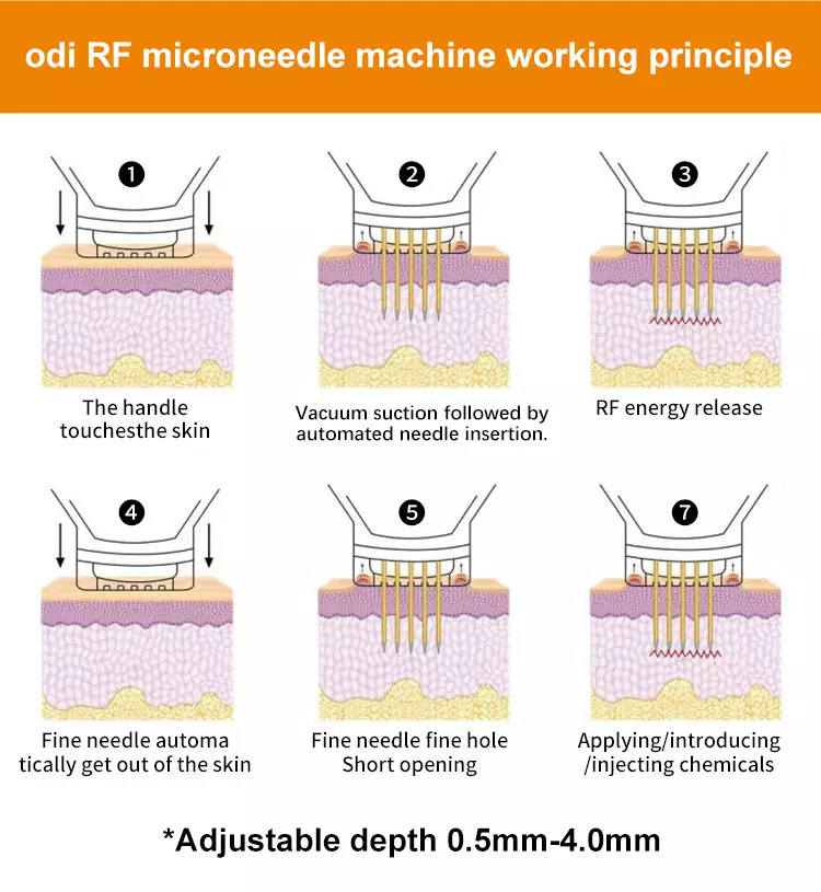 rf-microneedle-machine-for-face-and-body-working-principle