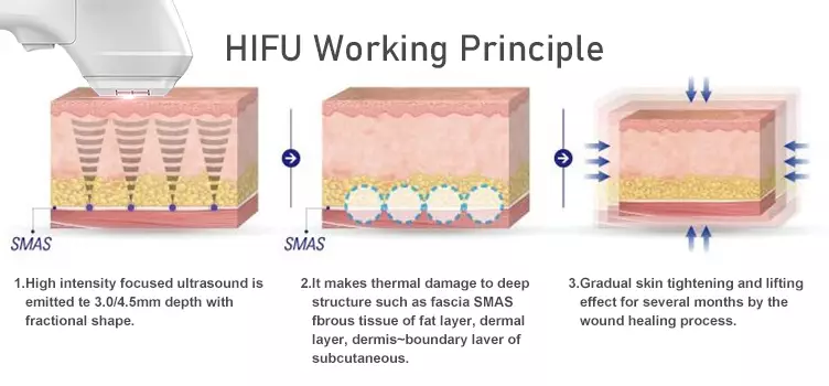 hifu-vs-rf