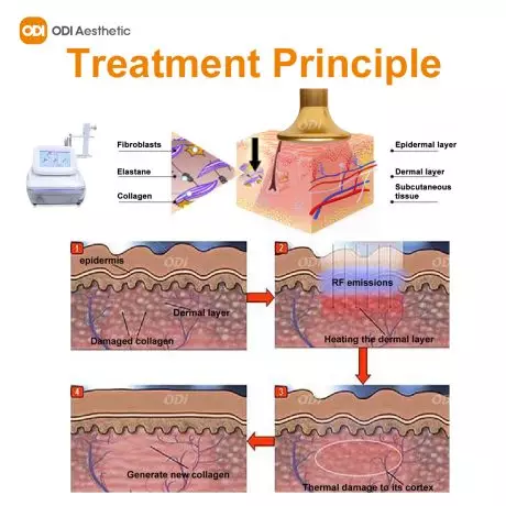 radio-frequency-skin-tightening-facial