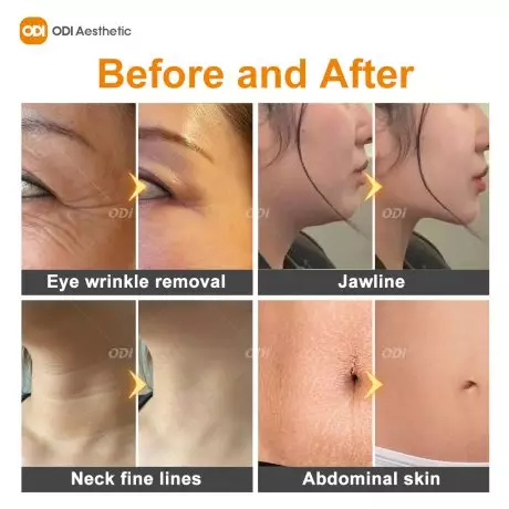 rf-face-tightening