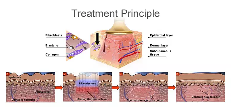 rf-lifting-facial-principle