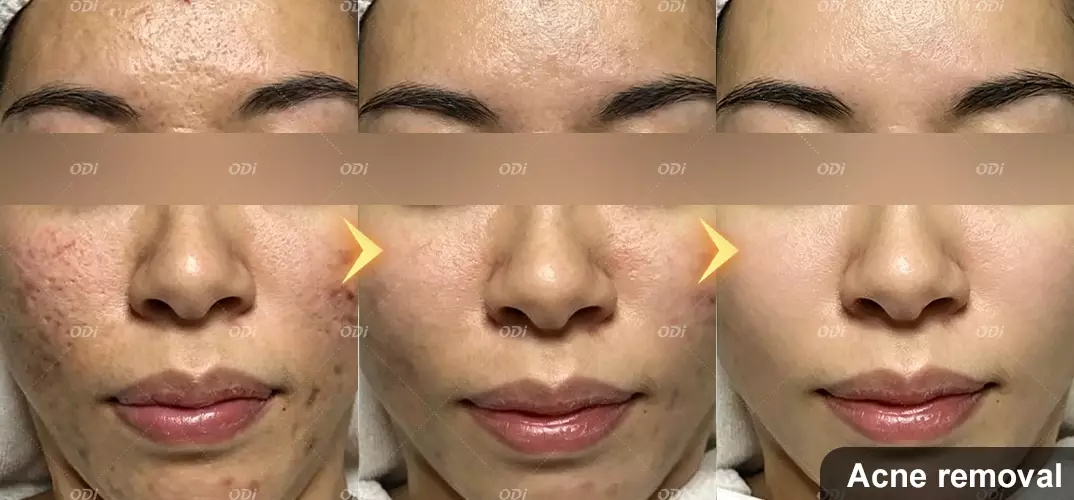 acne-removal