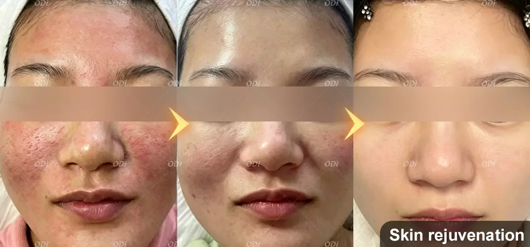 co2-fractional-laser-skin-rejuvenation-treatment