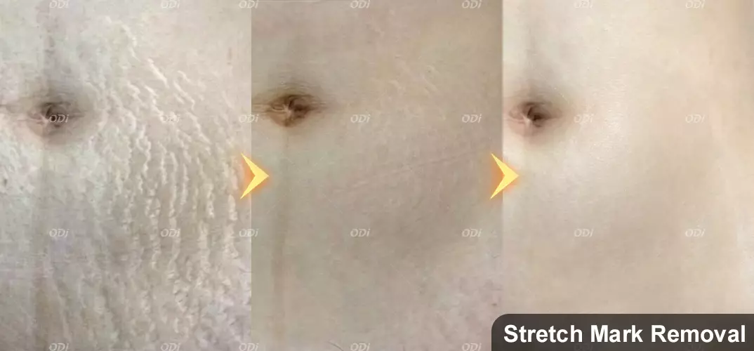co2-fractional-laser-streth-mark-removal-before-and-after