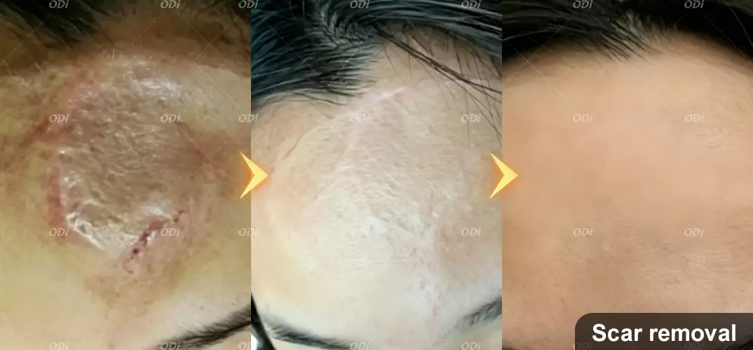 scar-removal