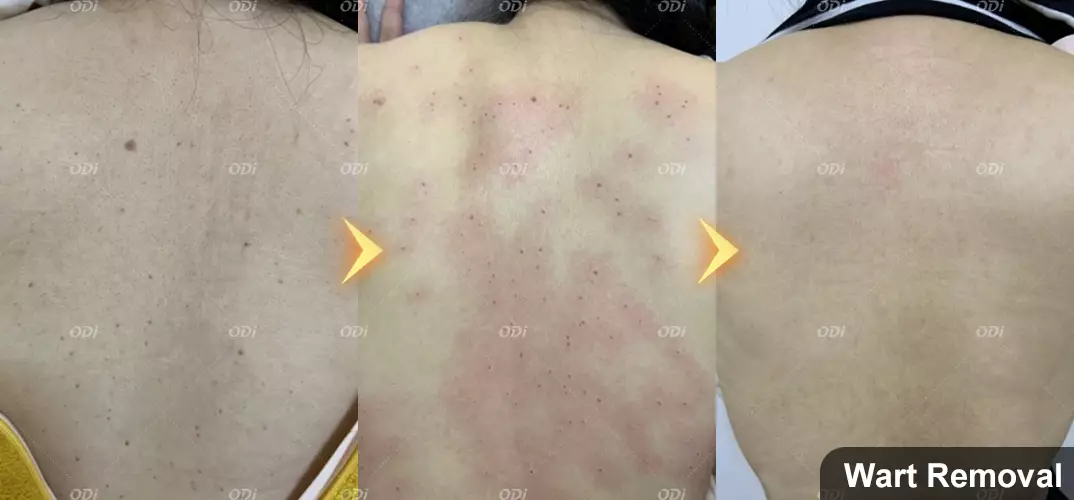wart-removal-treatment