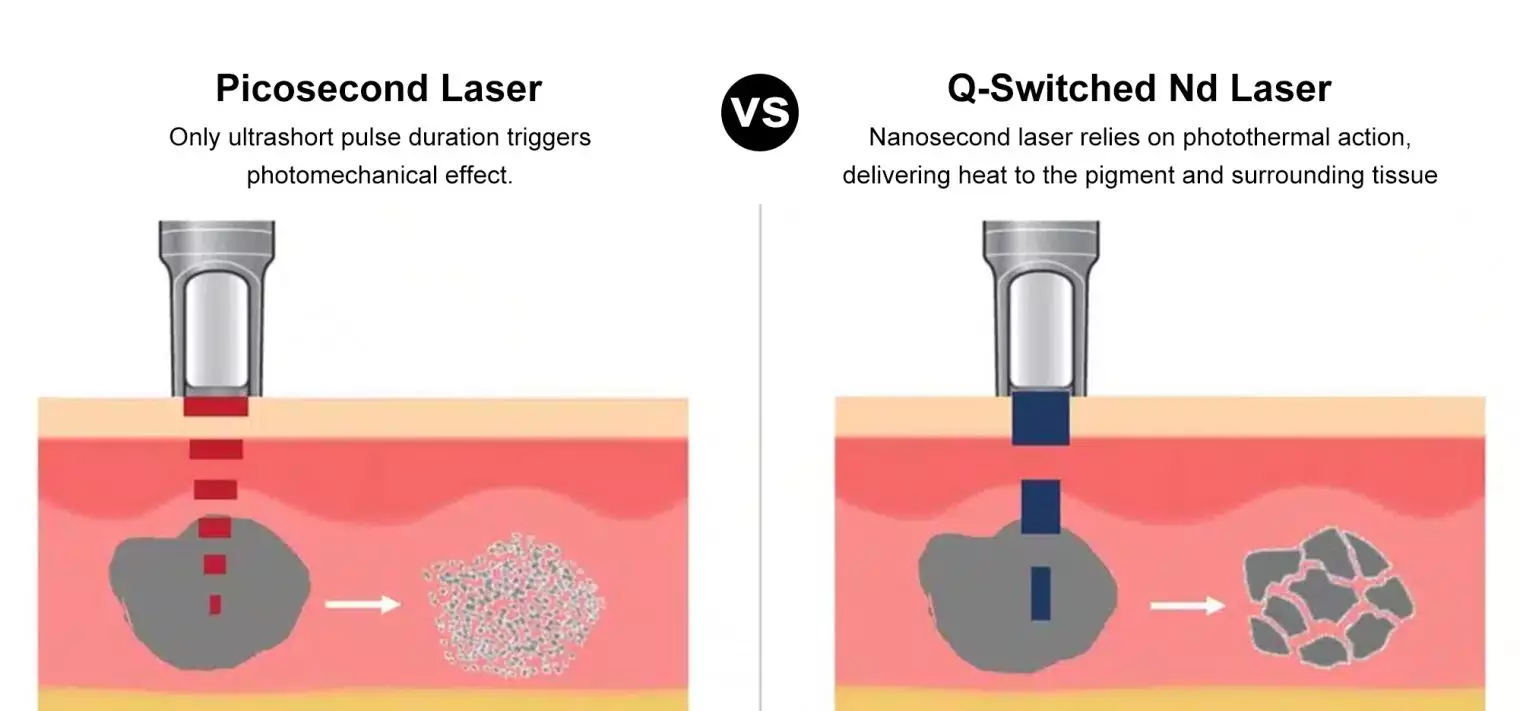 Picosecond-Laser-vs-Q-Switched-Nd-Yag-Laser