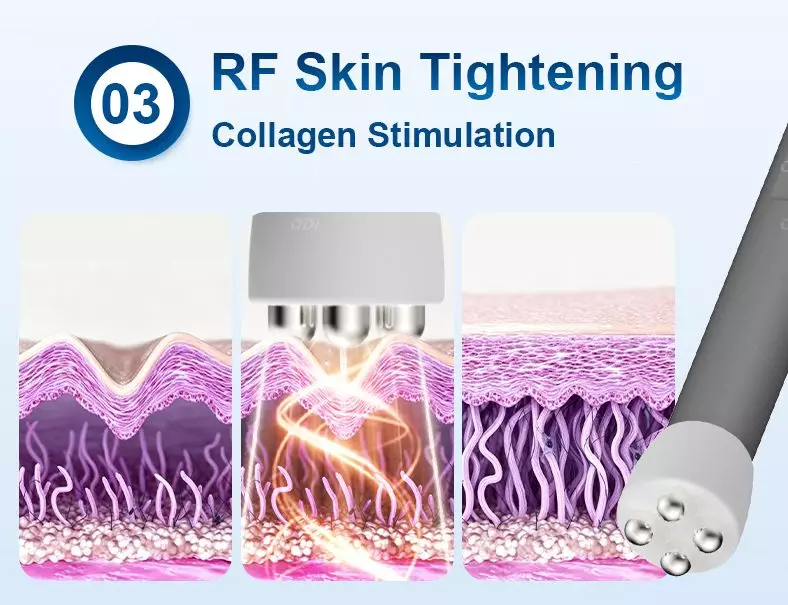 RF-skin-tightening-tip
