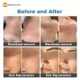 professional-hydrodermabrasion-machine