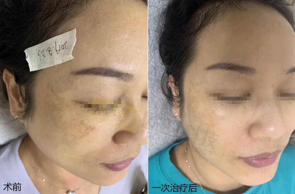 picosecond-laser-melasma-treatment