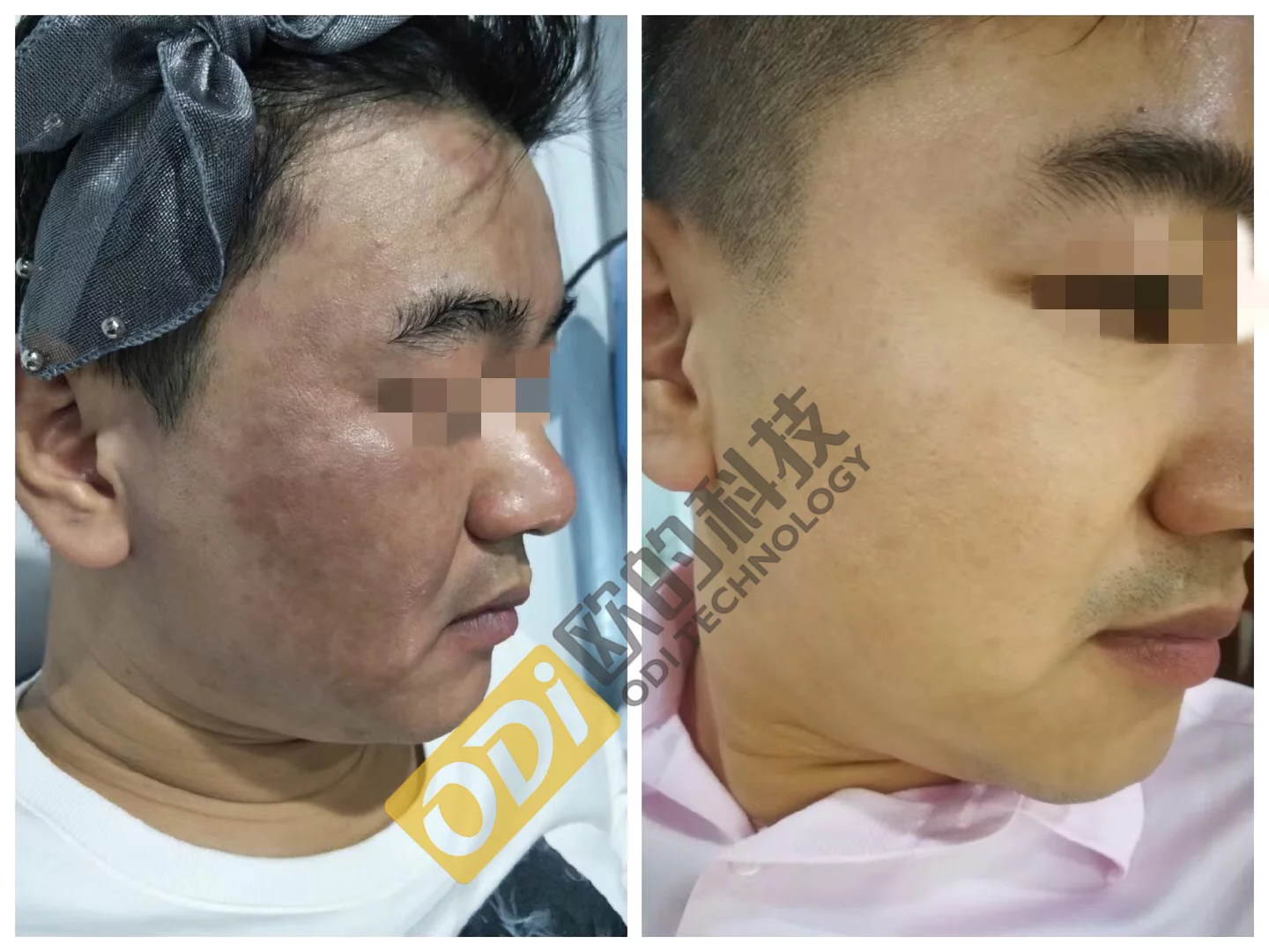 melasma-laser-treatment-machine