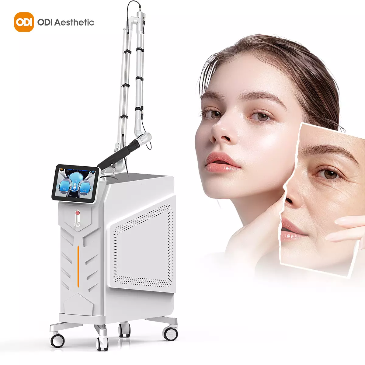 melasma-laser-treatment-machine
