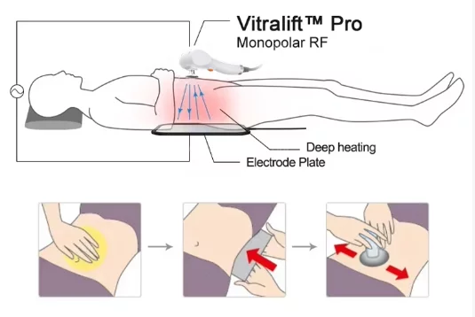 monopolar-rf-treatment