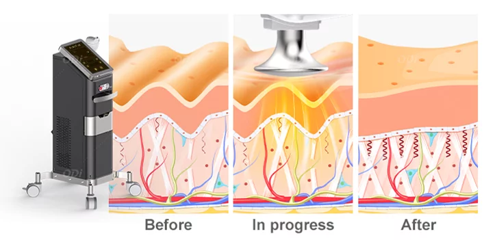 monopolar-rf-skin-tightening